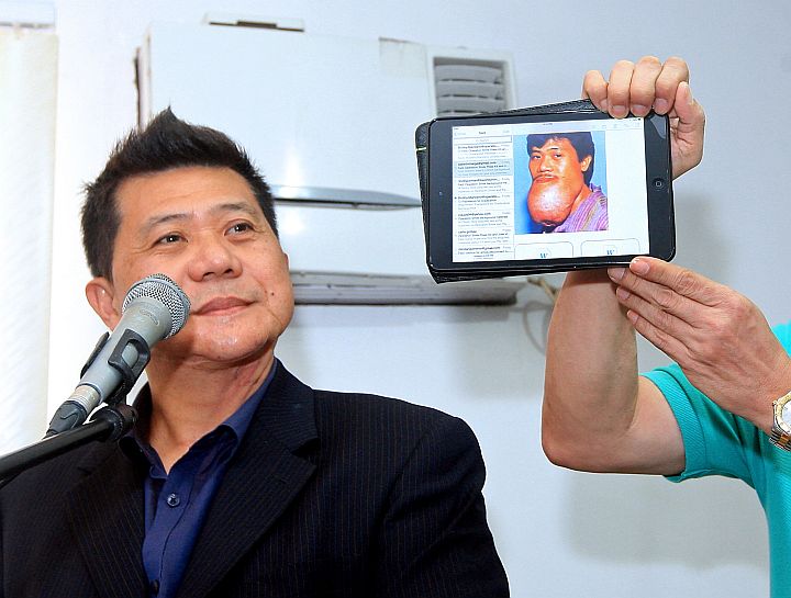 Former 'Operation Smile' beneficiary Jose Villegas shows what he looked like with the tumor on his chin prior to undergoing corrective surgery. 