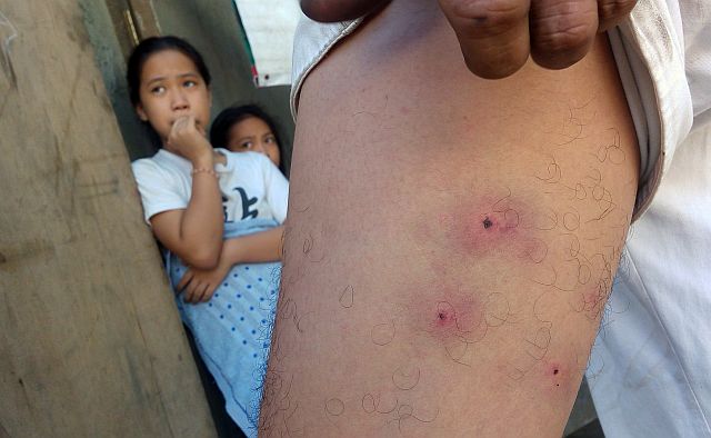 Faustino Mante of Barangay Casuntingan shows the bite marks inflicted by the rabid stray dog. (CDN PHOTO/TONEE DESPOJO)