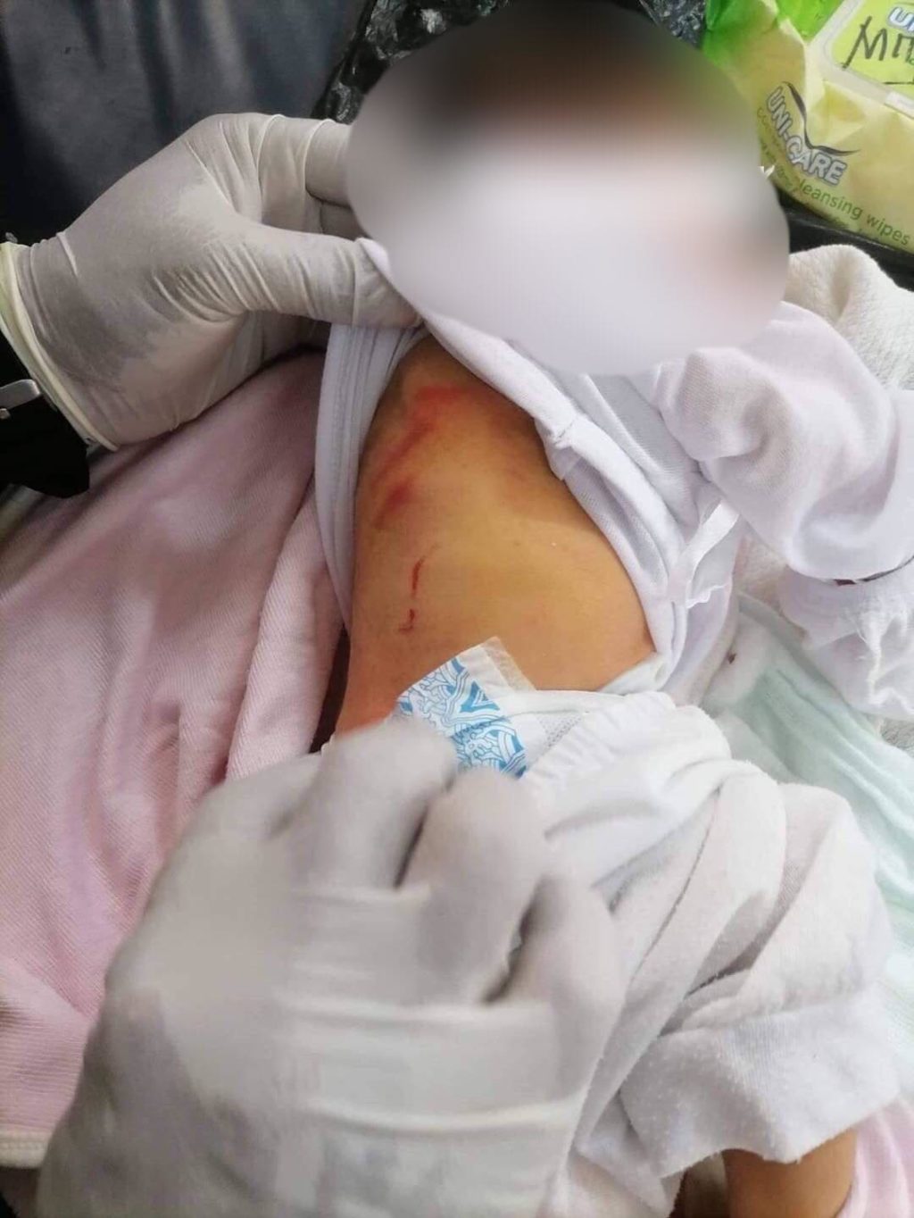 BABY GIRL RESCUED. Wounds at the back of the baby girl rescued at a vacant lot in Barangay Pajo in Lapu-Lapu City are believed to have been caused by animal bites. | Contributed photo via Futch Anthony Inso