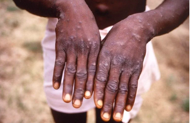 (FILE PHOTO) In this file handout photo provided by the Centers for Disease Control and Prevention taken in 1997 during an investigation into an outbreak of monkeypox, which took place in the Democratic Republic of the Congo (DRC), depicts the dorsal surfaces of a monkeypox case in a patient who was displaying the appearance of the characteristic rash during its recuperative stage. (Photo by Brian W.J. Mahy / Centers for Disease Control and Prevention / AFP)
