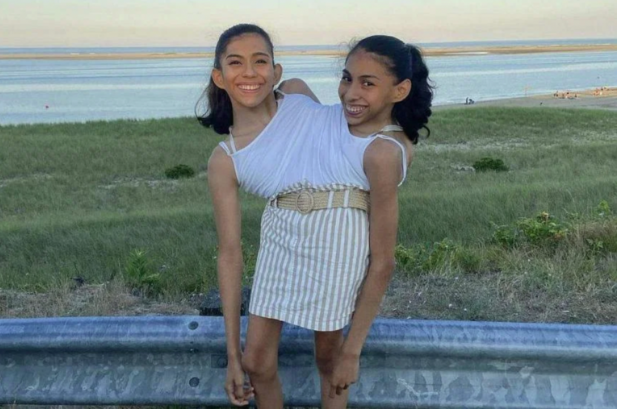 Conjoined twins Lupita and Carmen Andrade are connected at the torso and share a pelvis and reproductive system. PHOTO: CARMEN_ANDRADE2000/INSTAGRAM