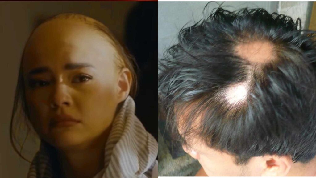 Hair loss due to Alopecia.