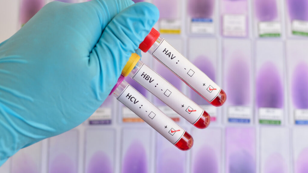‘Viral hepatitis’: Philippines among countries facing this ‘silent killer’ disease. Blood samples testing positive for three (of five) main strains of the hepatitis virus —INQUIRER.net stock image