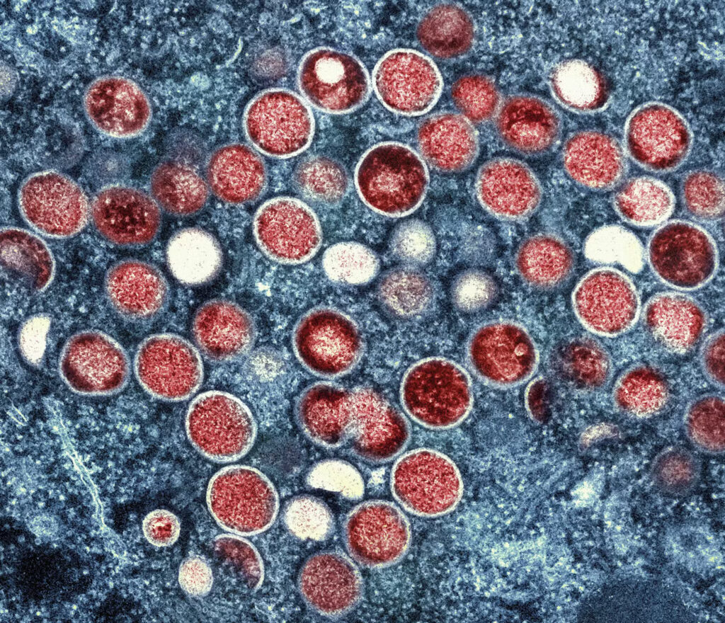 FILE PHOTO: This undated image provided by the National Institute of Allergy and Infectious Diseases shows a colorized transmission electron micrograph of monkeypox particles (red) found within an infected cell (blue), cultured in the laboratory, that was captured and color-enhanced at the NIAID Integrated Research Facility in Fort Detrick, Maryland. In the Philippines, a new case of mpox (formerly monkeypox) has been detected, the Department of Health (DOH) reports on Monday, August 19, 2024. | NIAID via Associated Press, File