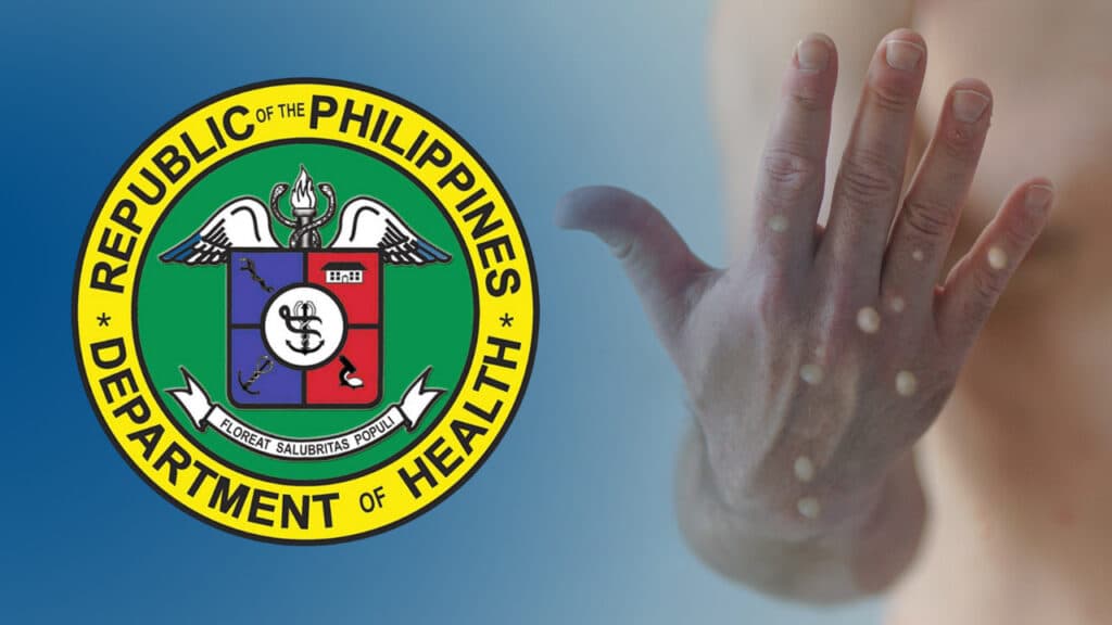 DOH-7 clarifies: 'No confirmed' cases of mpox in Central Visayas. In photo is a close-up of a hand with mpox symptoms.