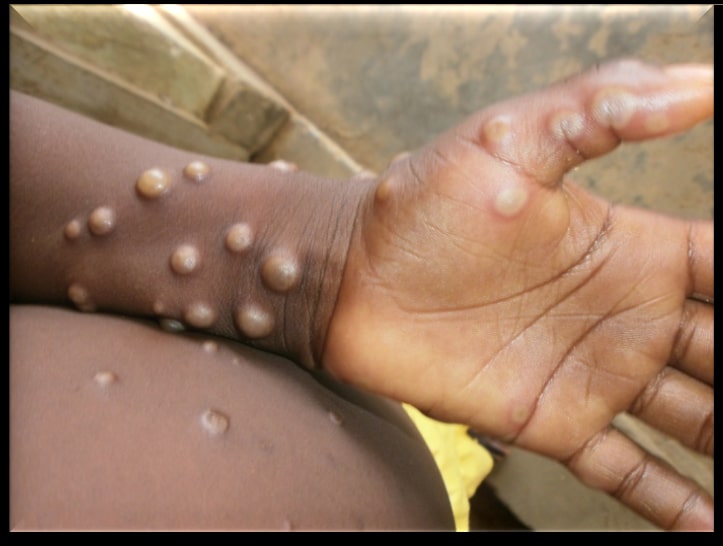 Mpox: Droplets a ‘minor’ route of transmission, says WHO