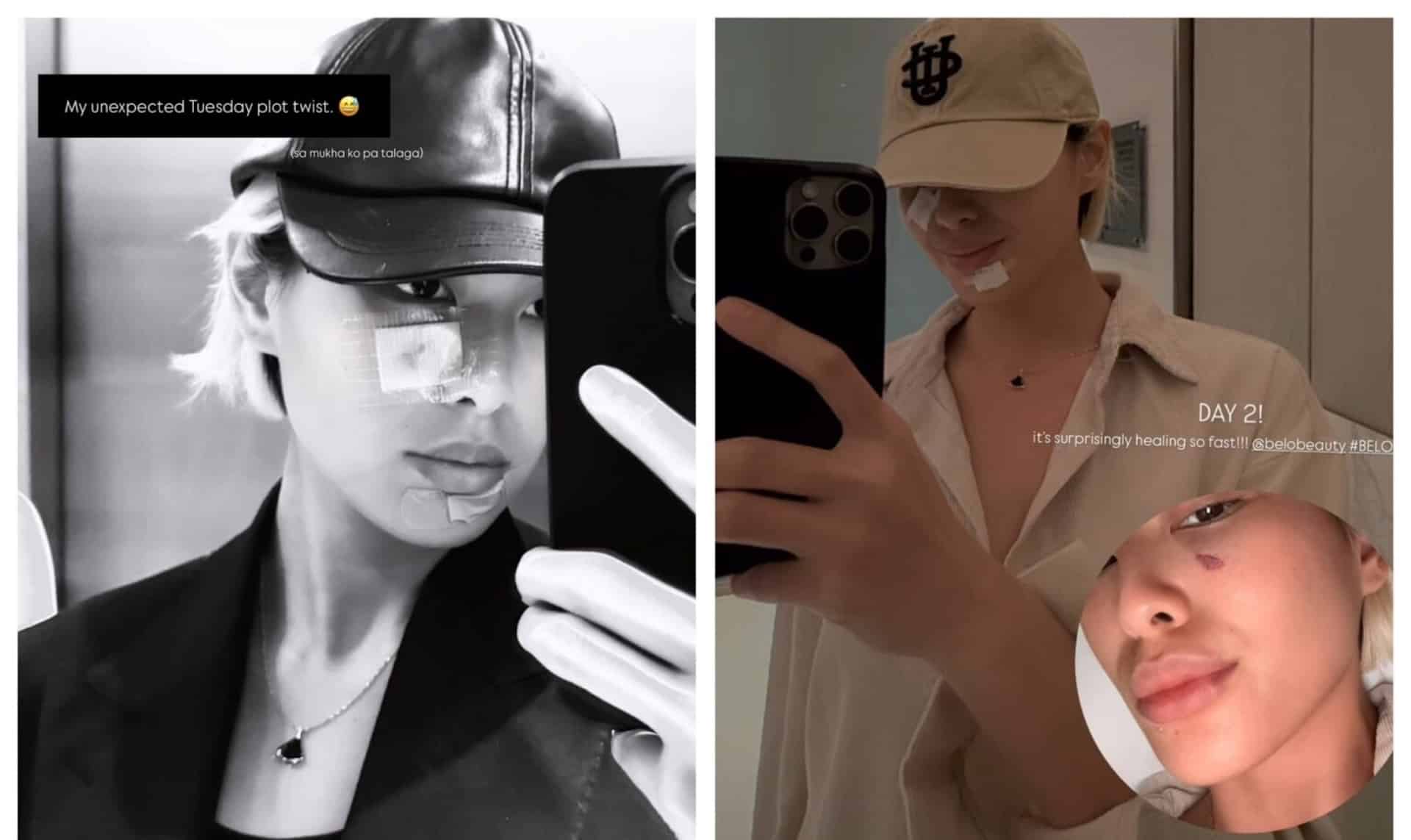 Dog bites actress; Philippines' DOH issues rabies warning | News Minimalist